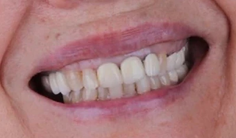 Sonrisa antes del tratamiento