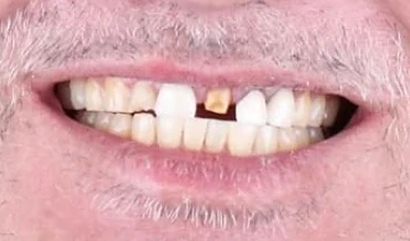 Sonrisa antes del tratamiento