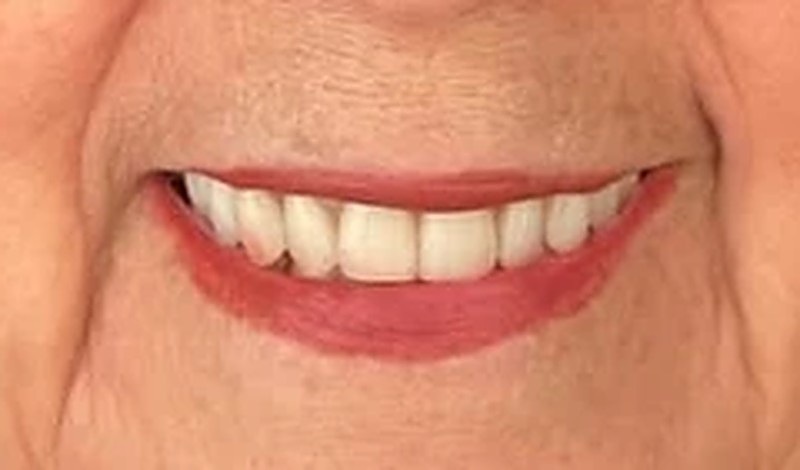 Sonrisa después del tratamiento