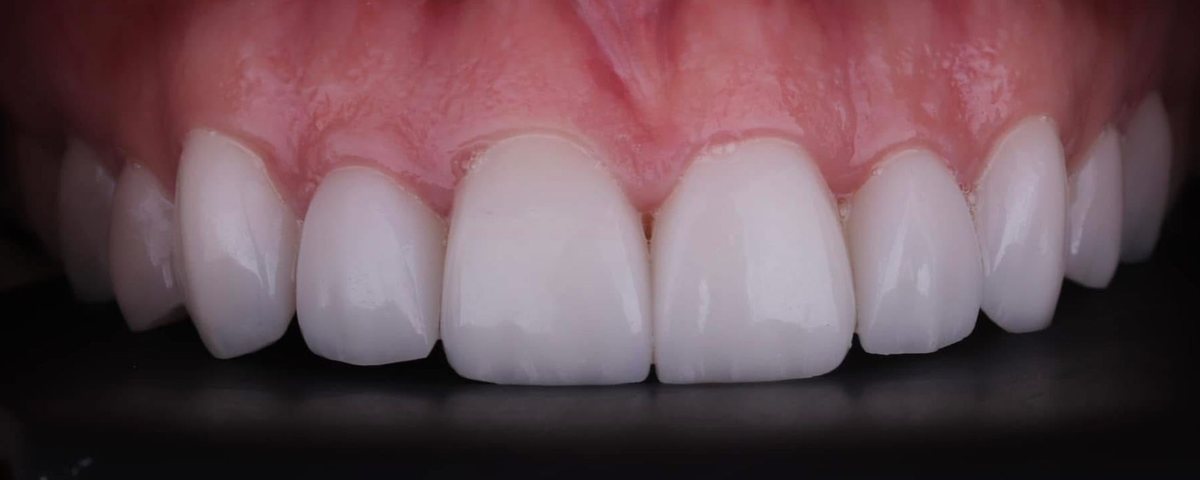 Carillas e.max en dientes superiores